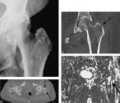 Early diagnosis of occult hip fractures- MRI versus CT scan