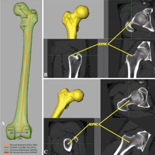 Functional and anatomic orientation of the femoral head