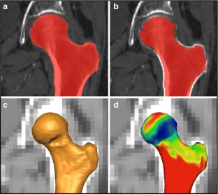 Subchondral bone density distribution in the human femoral head