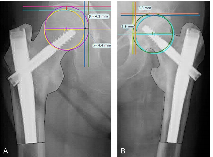 Proximal Femoral Shortening After Cephalomedullary Nail Insertion for Intertrochanteric Fractures
