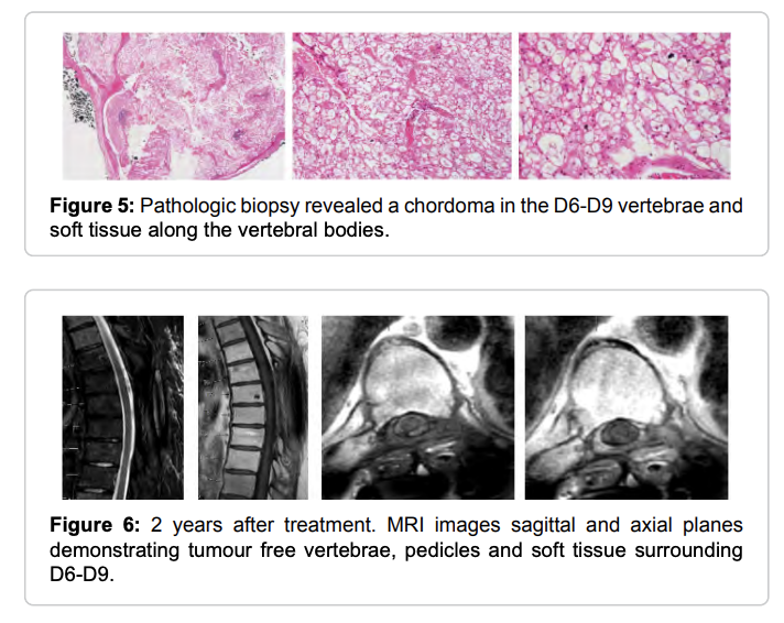 Chordoma in the Thoracolumbar Spine: A Case Report